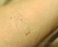 Morsure de P'tite princesse